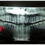 Pengalaman Operasi Gigi Bungsu